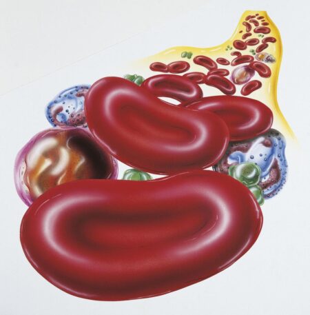 Why Anemia Is Highly Prevalent Among Women In The Global South