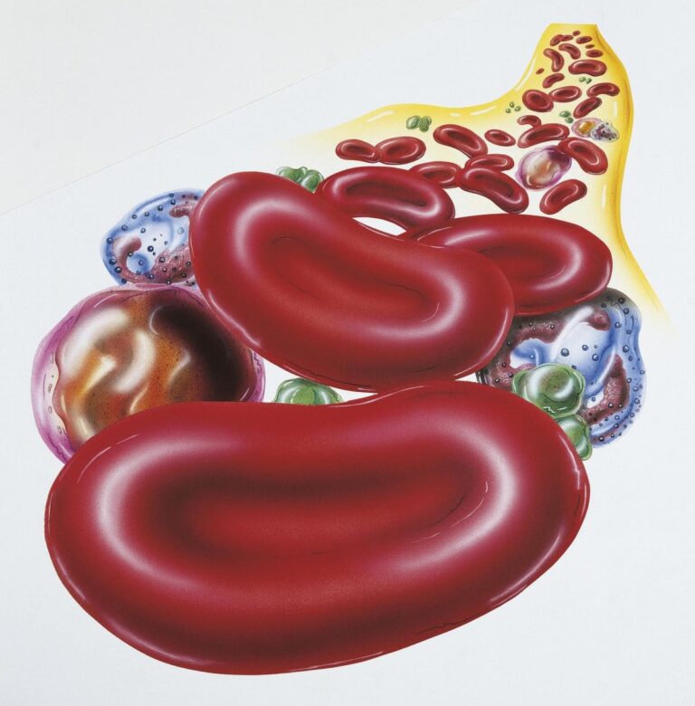 Why Anemia Is Highly Prevalent Among Women In The Global South