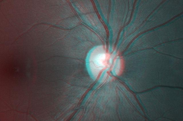 Fight Against Macular Edema: The Power Of Antibodies Unleashed