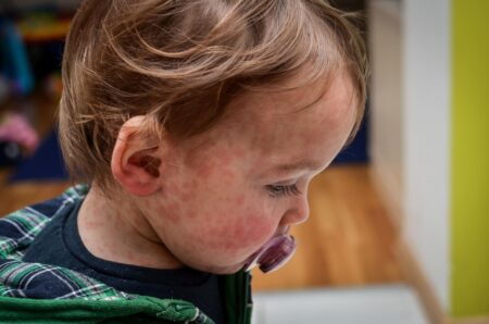 Major Measles Outbreak Erupts In England As Vaccine Hesitancy Increases