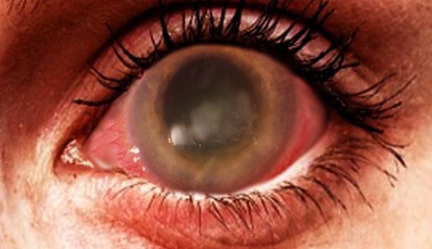 Restoring Sight With Science: The Promising Future Of Corneal Infection Treatment